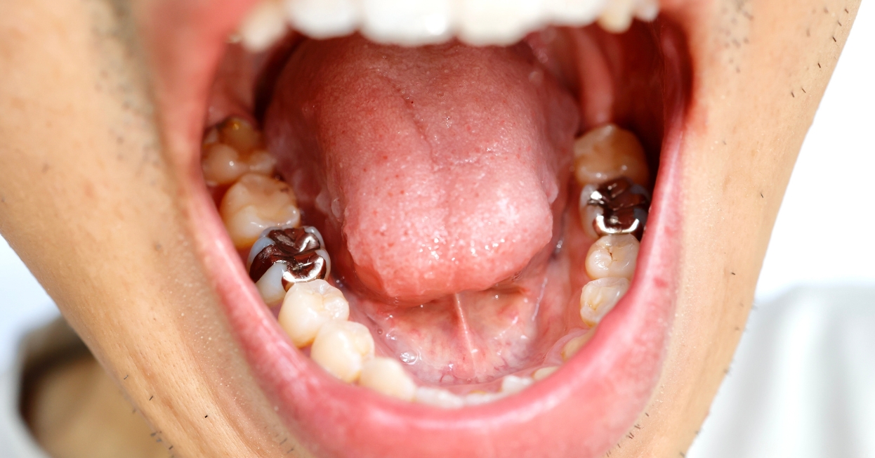 Silver fillings