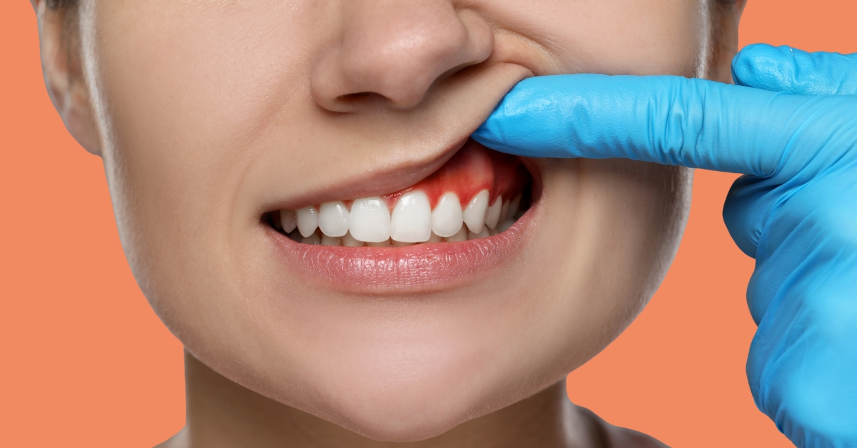Gum disease
