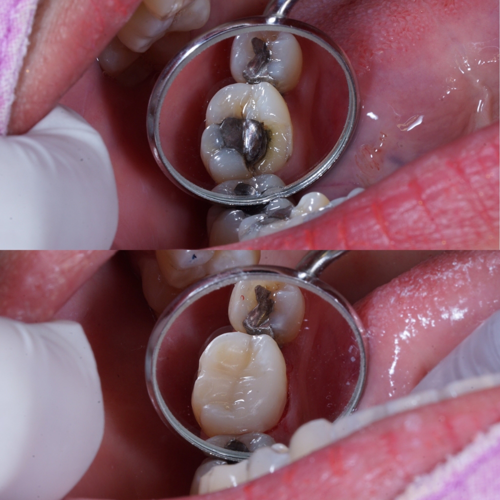 Composite White Fillings